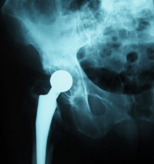 X-ray of a hip joint with a metal prosthesis and artificial femoral head.