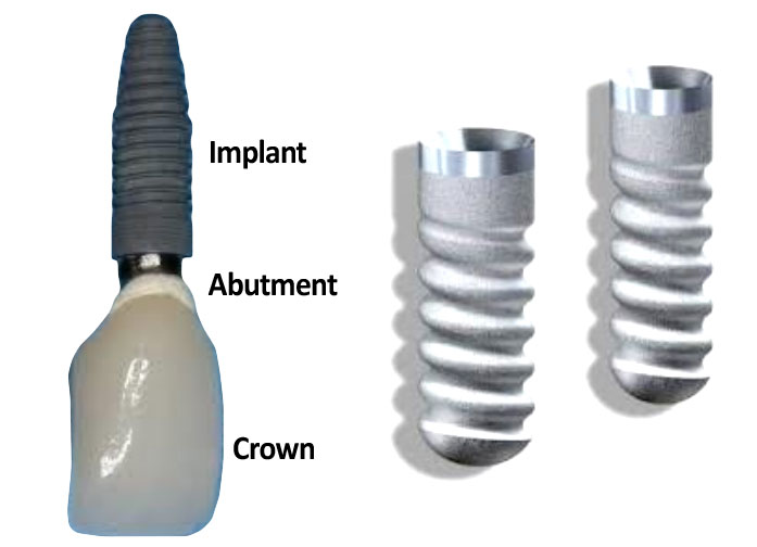 Dental implant diagram showing crown, abutment, and implant on the left and two implant screws on the right.
