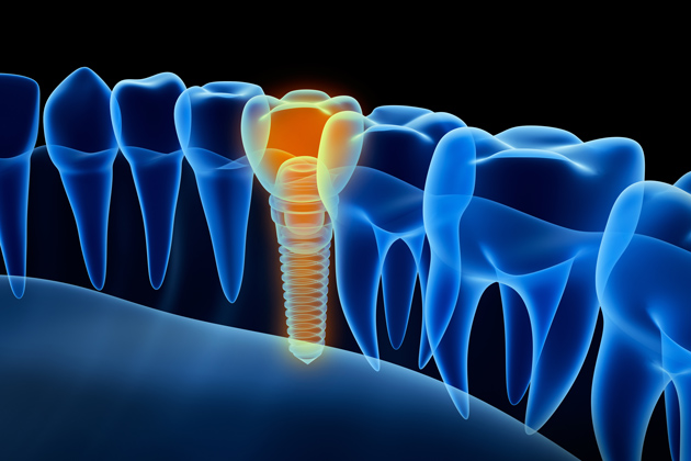 Cross-sectional view of a dental implant anchored in the jawbone beside natural teeth.